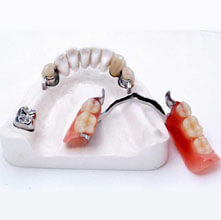 Комплектующие и элементы зубных протезов