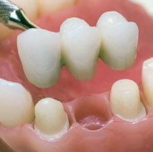 Адгезивные системы