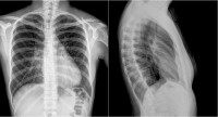 Рентгенография органов грудной клетки в двух проекциях